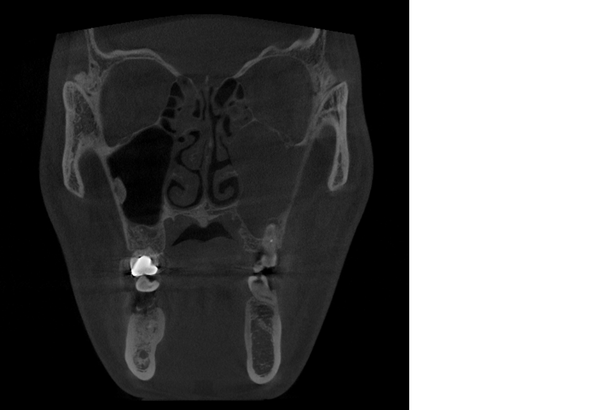 左上顎洞の陰影と歯根部の透過像を認める歯性上顎洞炎疑いのCT画像
